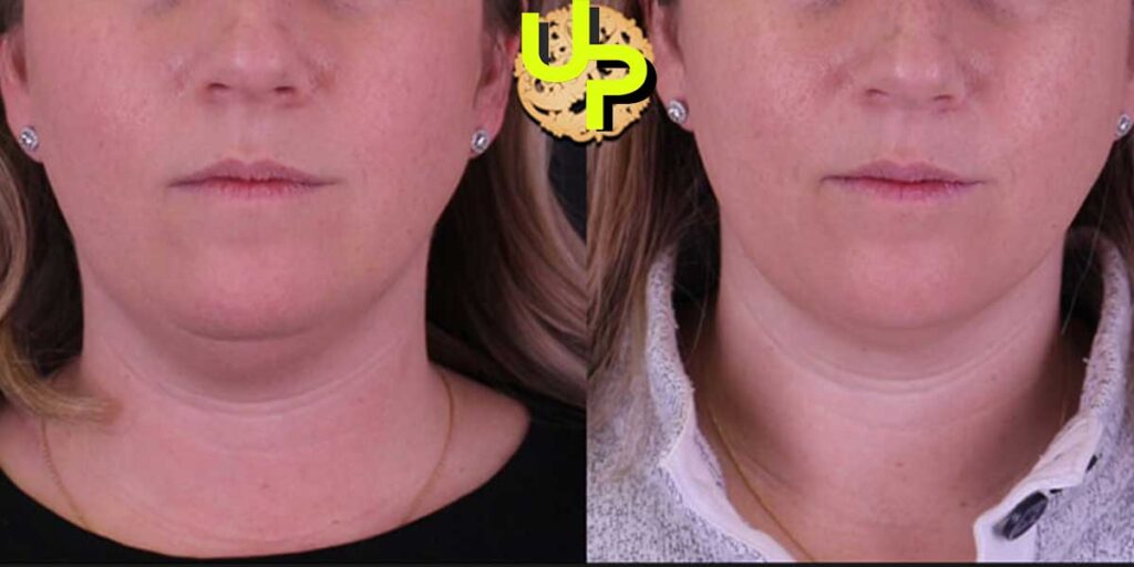 Lose Face Fat Cosmetic Procedures results
